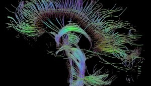 "DTI Sagitall Fibers in the Living Brain"